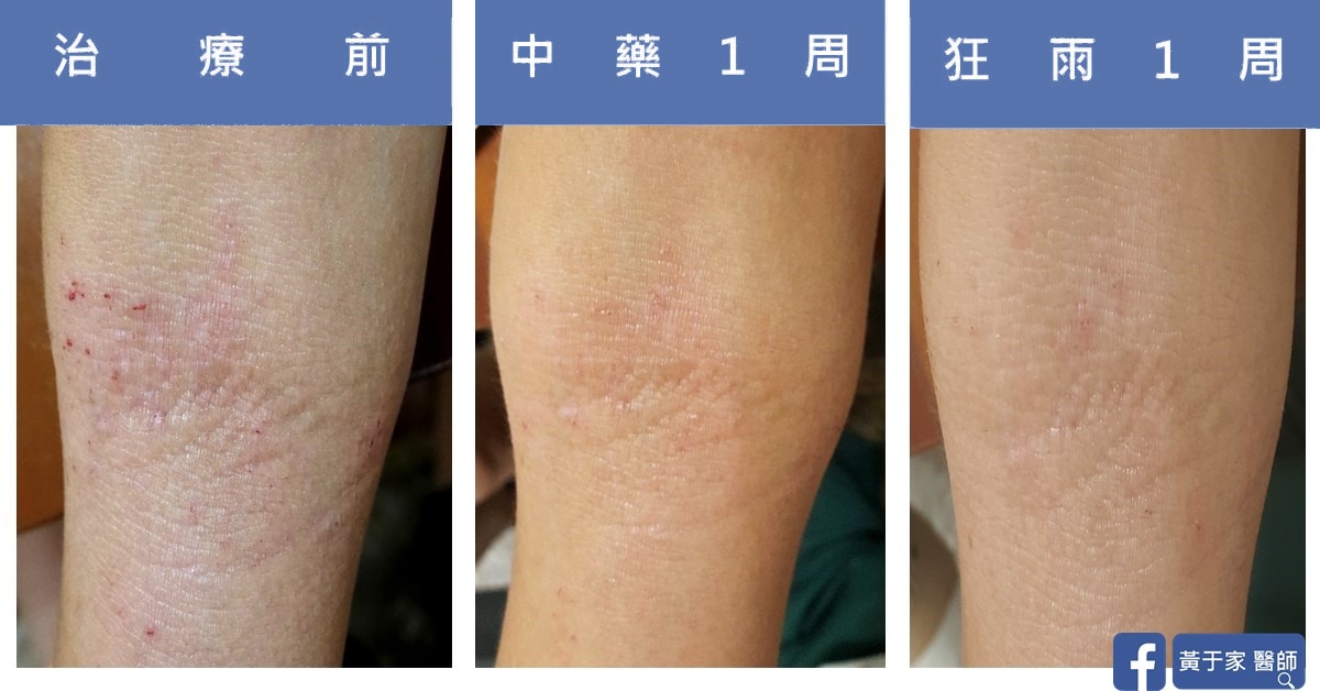 梅雨我不怕!不讓連日豪雨阻礙您異位性皮膚炎康復之路