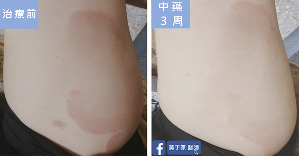 同一位患者身體側面乾癬斑塊的比對,左標示「治療前」,可見邊界清楚的紅色斑塊;右標示「中藥 3 周」,斑塊顏色變淡、邊界模糊