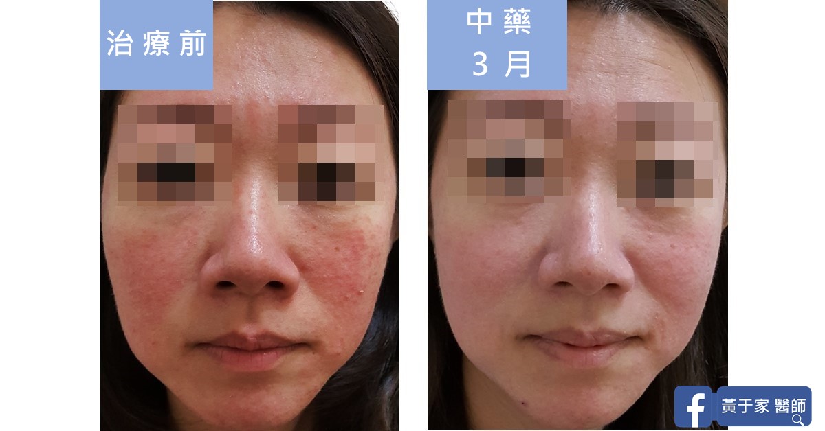 同一位患者正面臉部的比對,左標示「治療前」,右標示「中藥 3 月」