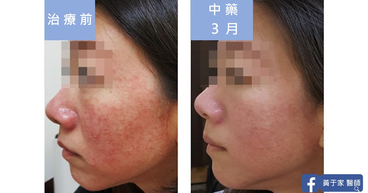 同一位患者左側臉的比對,左標示「治療前」,右標示「中藥 3 月」