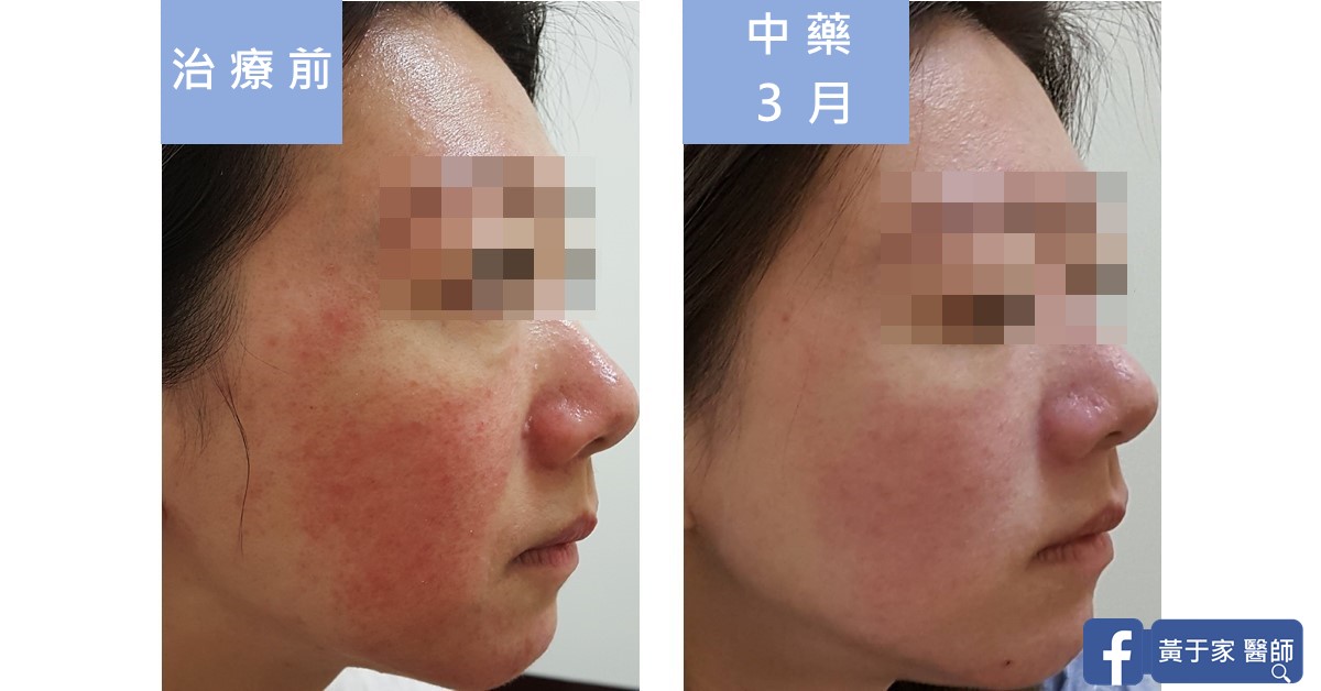 同一位患者右側臉的比對,左標示「治療前」,右標示「中藥 3 月」