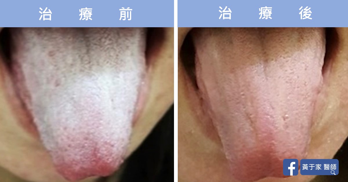 同一位患者舌象的比對,左標示「治療前」,舌苔白厚;右標示「治療後」,舌苔變薄