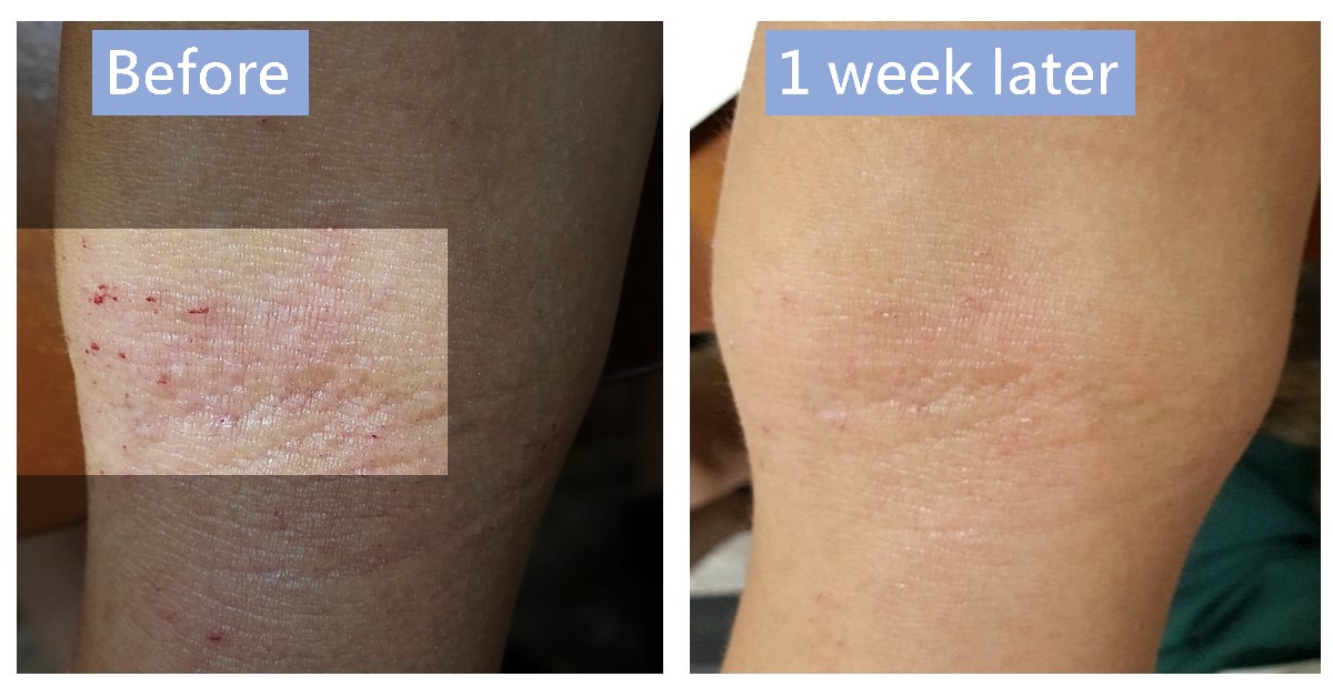 Side-by-side photos of the same area of skin, labelled “Before” and “1 week later”