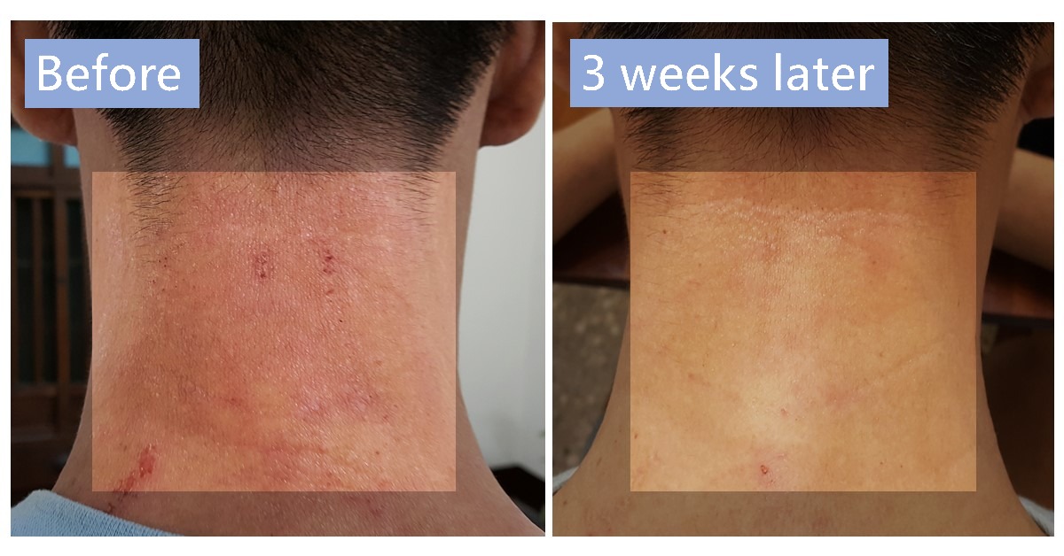 Back of the neck, labelled “Before” and “3 weeks later”