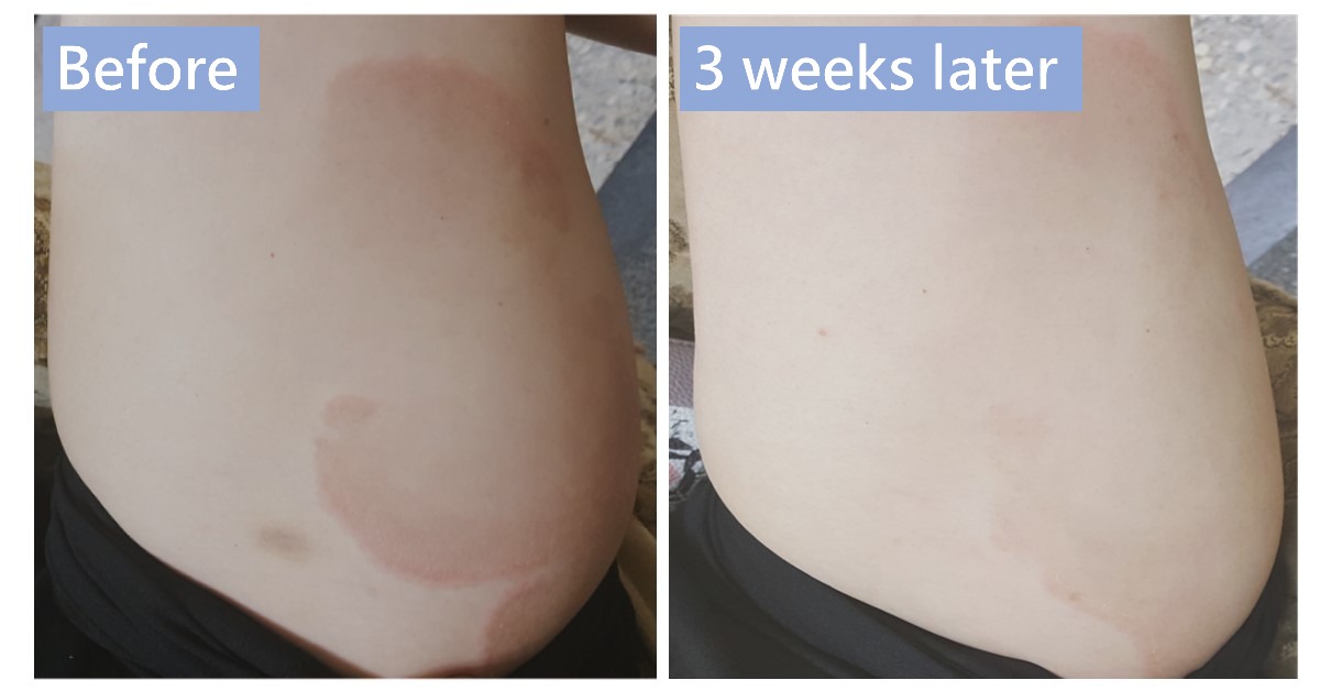 Side of the waist with red patches, labelled “Before” and “3 weeks later”