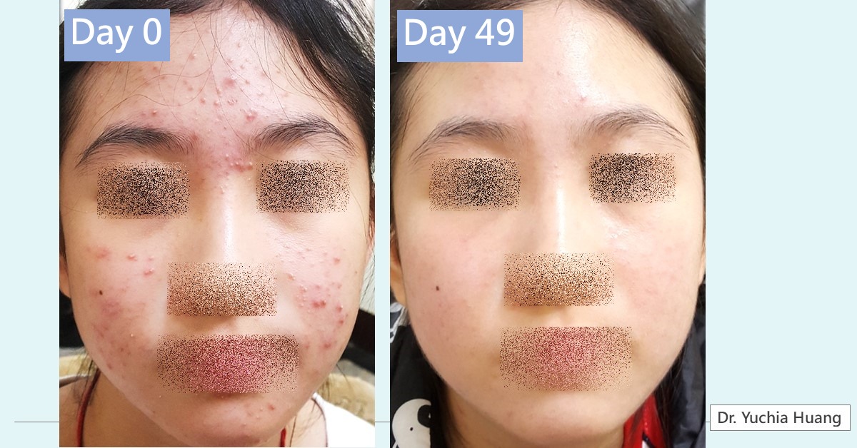 Face with acne, eyes, nose and mouth pixelated, labelled “Day 0” and “Day 49”