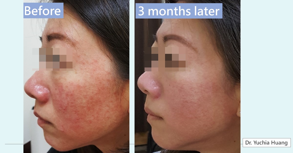 Side view of a face with redness on the cheek, labelled “Before” and “3 months later”