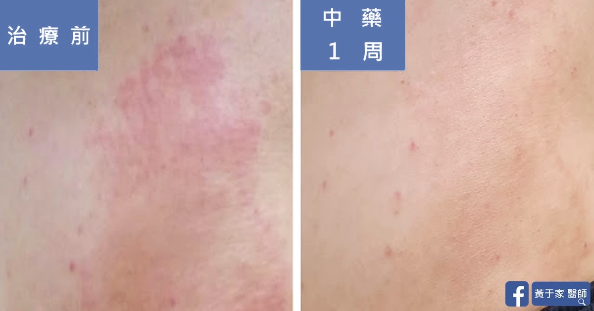大雨大雨一直下!類固醇藥膏搞不定的搔癢(圖 1)