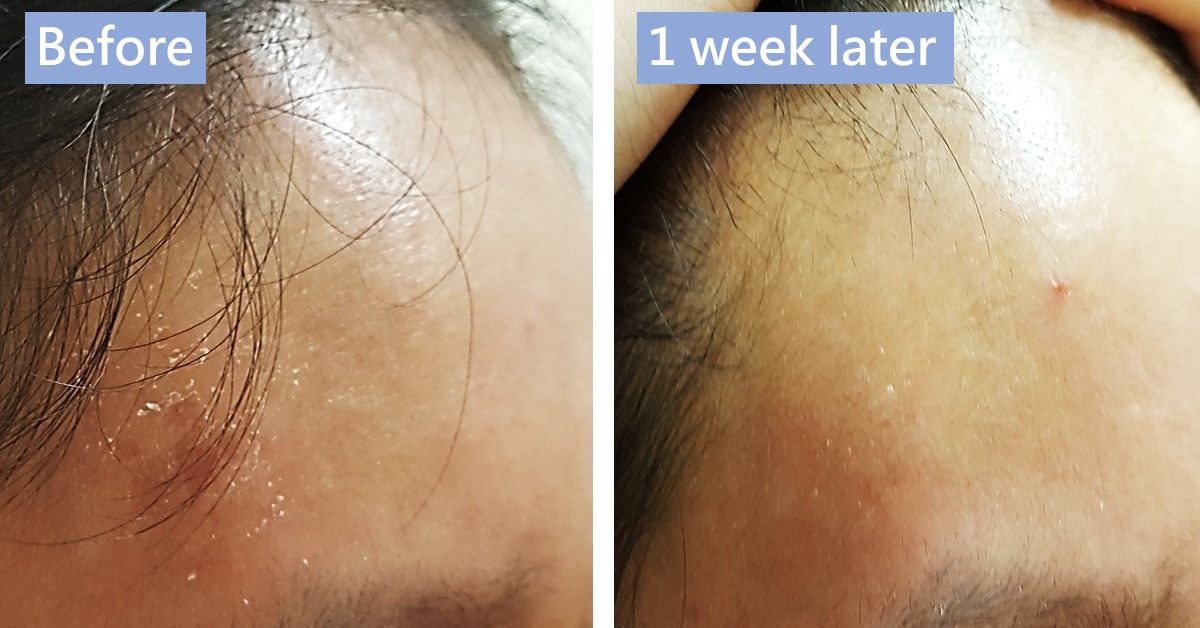 Before-and-after photos of the skin at the hairline and temple, labelled “Before” and “1 week later”