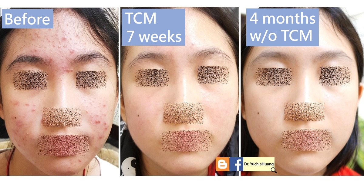 Before-and-after photos of a face with acne, eyes, nose and mouth obscured, labelled “Before”, “TCM 7 weeks” and “4 months w/o TCM”
