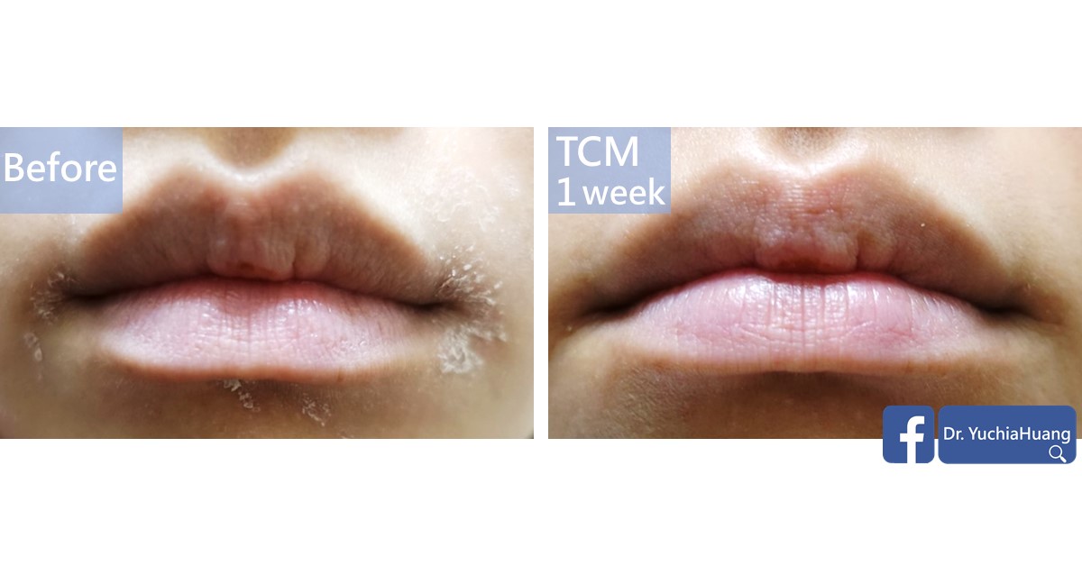 Before-and-after photos of dry, peeling lips, labelled “Before” and “TCM 1 week”