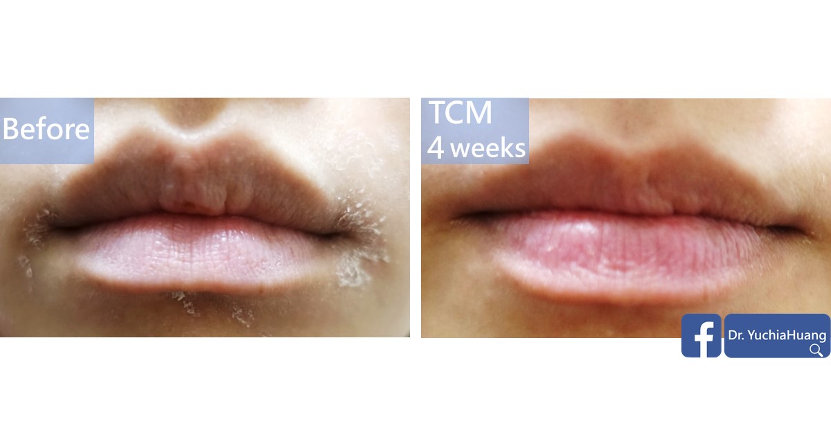 Before-and-after photos of dry, peeling lips, labelled “Before” and “TCM 4 weeks”