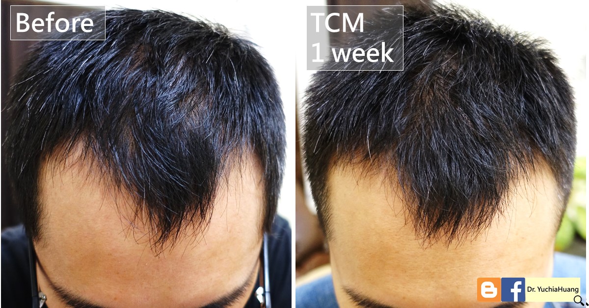 Before-and-after photos of a man’s hair seen from the front, labelled “Before” and “TCM 1 week”