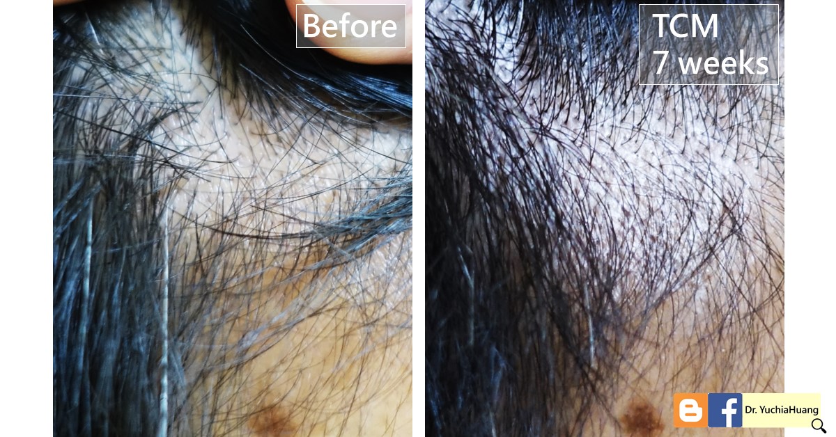 Before-and-after photos of thinning hair at the scalp, labelled “Before” and “TCM 7 weeks”
