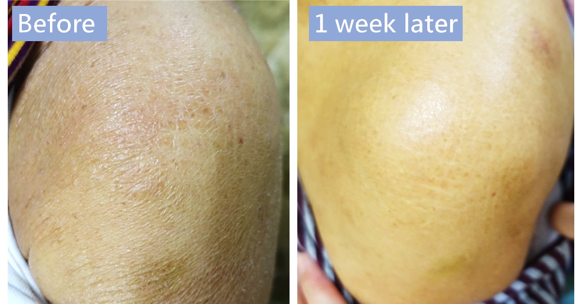 Before-and-after photos of dry, scaly skin, labelled “Before” and “1 week later”