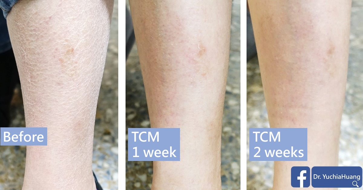 Before-and-after photos of dry skin on the lower legs, labelled “Before”, “TCM 1 week” and “TCM 2 weeks”