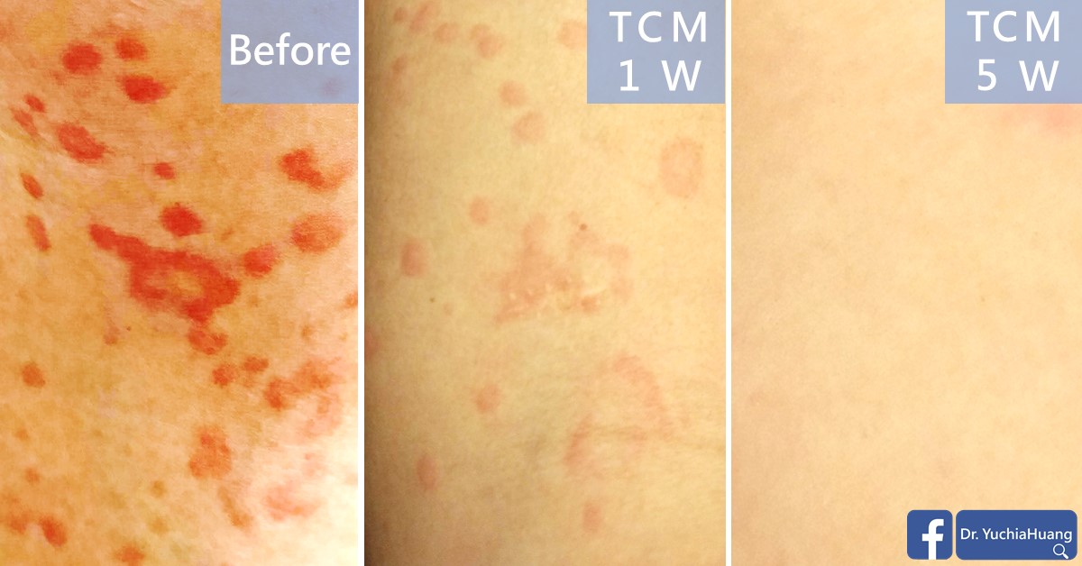 Before-and-after photos of skin with red hives, labelled “Before”, “TCM 1 week” and “TCM 5 weeks”