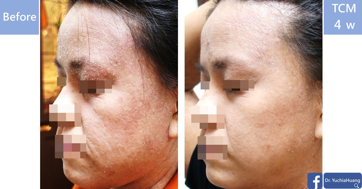 Before-and-after photos of the side of a face with dry, red skin, labelled “Before” and “TCM 4 weeks”