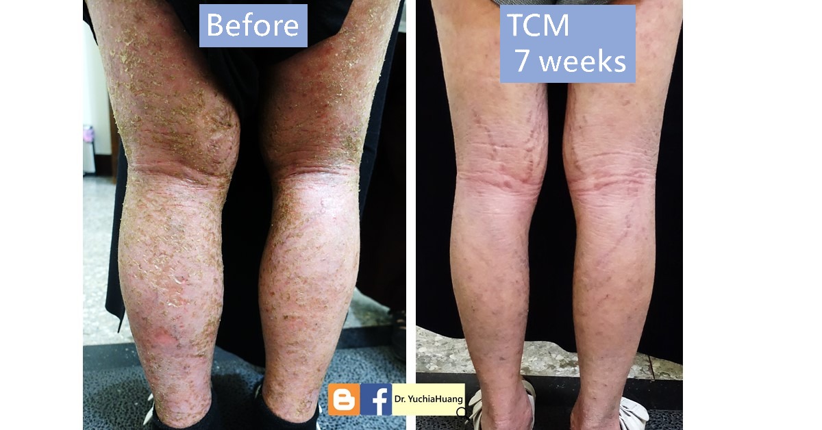 Before-and-after photos of the back of the legs with atopic dermatitis, labelled “Before” and “TCM 7 weeks”