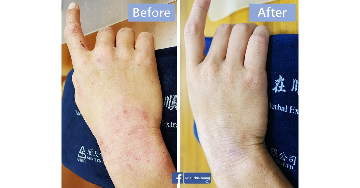 Before-and-after photos of a wrist and forearm, labelled “Before” and “After”
