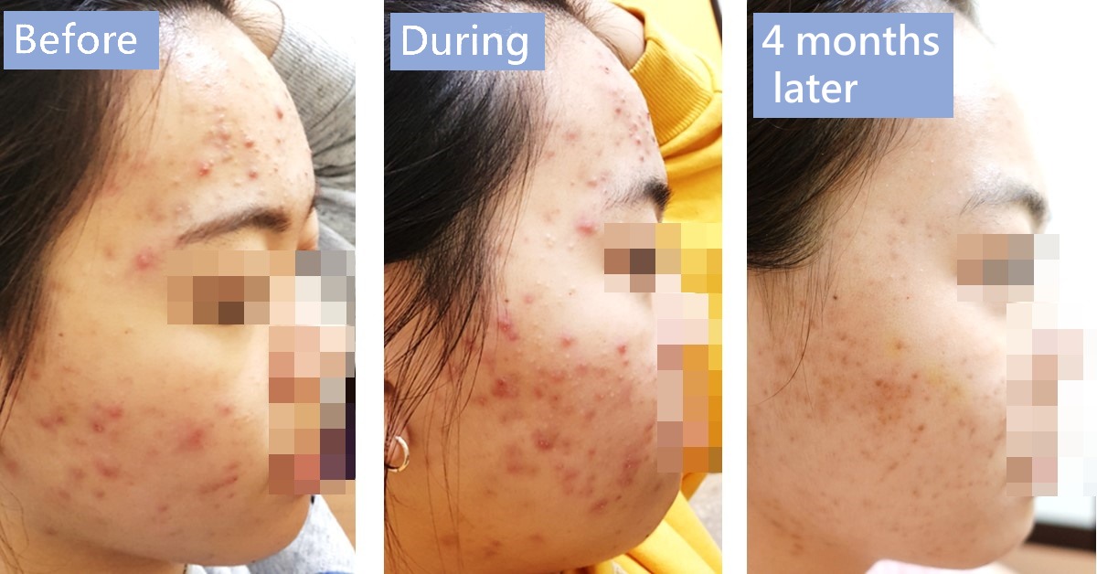 Before-and-after photos of the side of a face with acne, labelled “Before”, “During” and “4 months later”