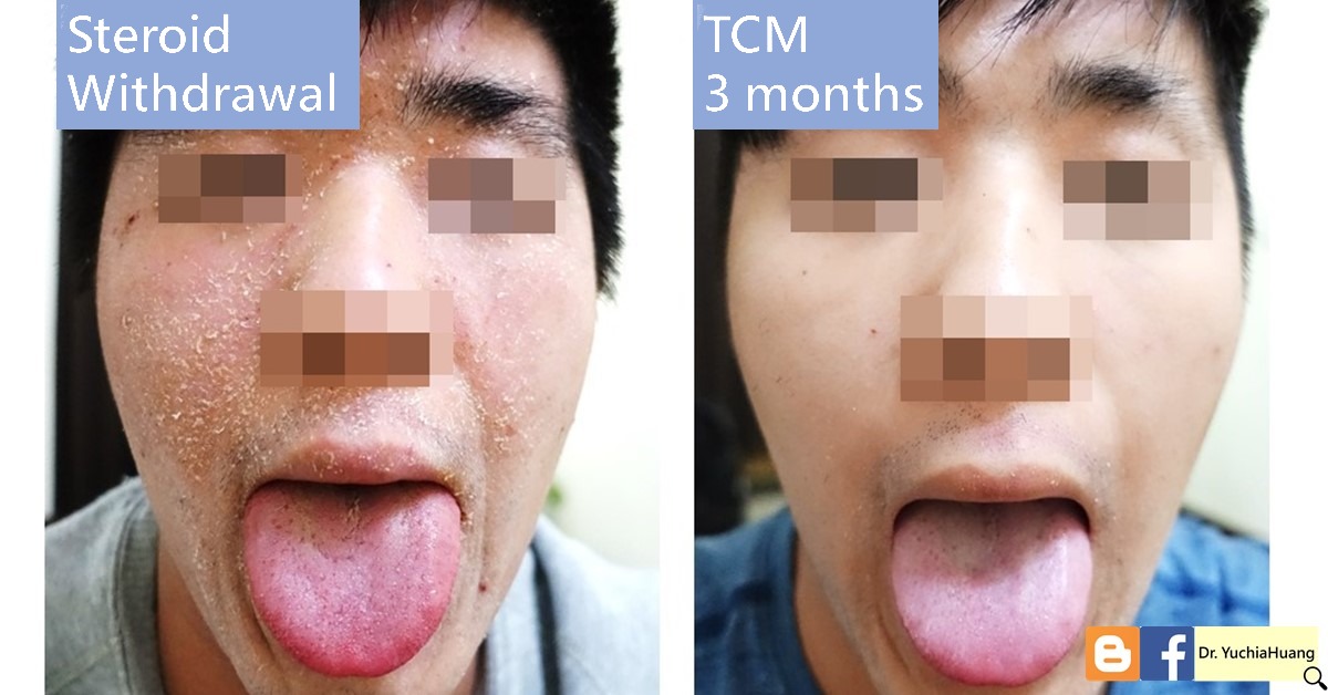 Before-and-after photos of a young man’s face and tongue during steroid withdrawal, labelled “Withdrawal” and “TCM 3 months”