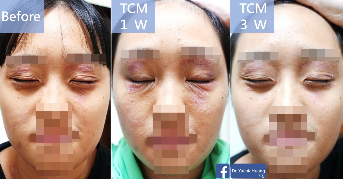 Before-and-after photos of a face with red skin around the eyes, features obscured, labelled “Before”, “TCM 1 week” and “TCM 3 weeks”