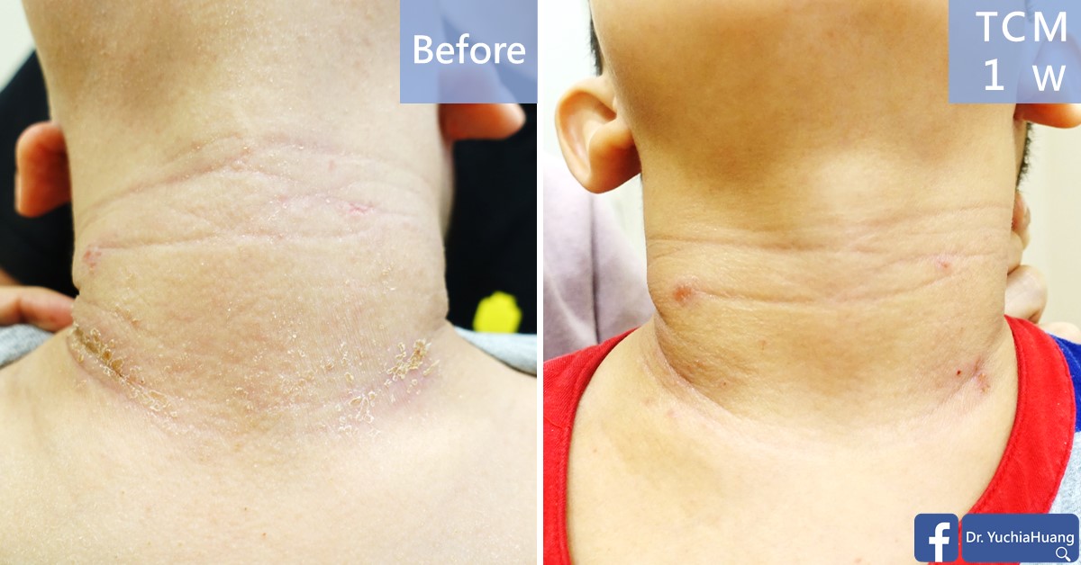 Before-and-after photos of a child’s neck, labelled “Before” and “TCM 1 week”
