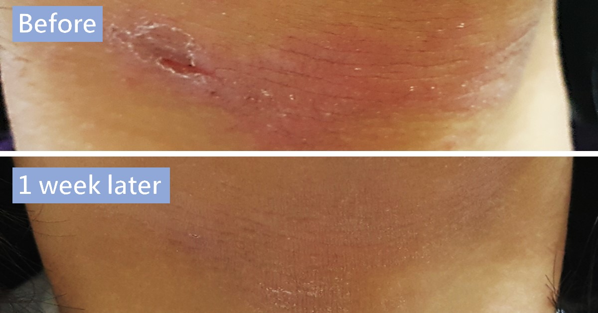 Before-and-after photos of dry, broken skin, labelled “Before” and “1 week later”