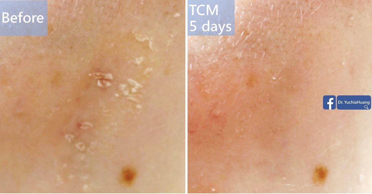 Before-and-after photos of a close-up of flaking skin, labelled “Before” and “TCM 5 days”