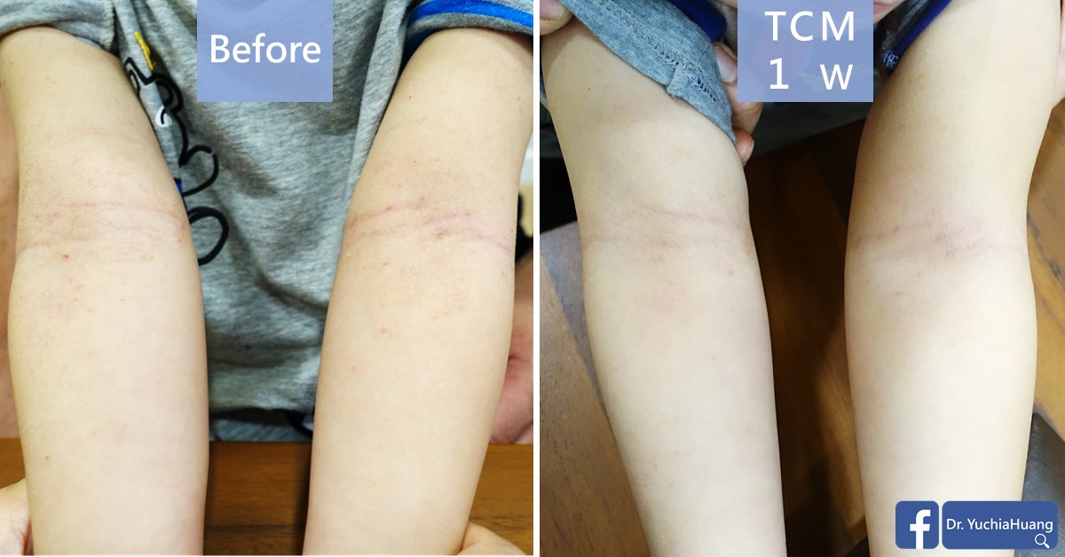 Before-and-after photos of the inner arms, labelled “Before” and “TCM 1 week”