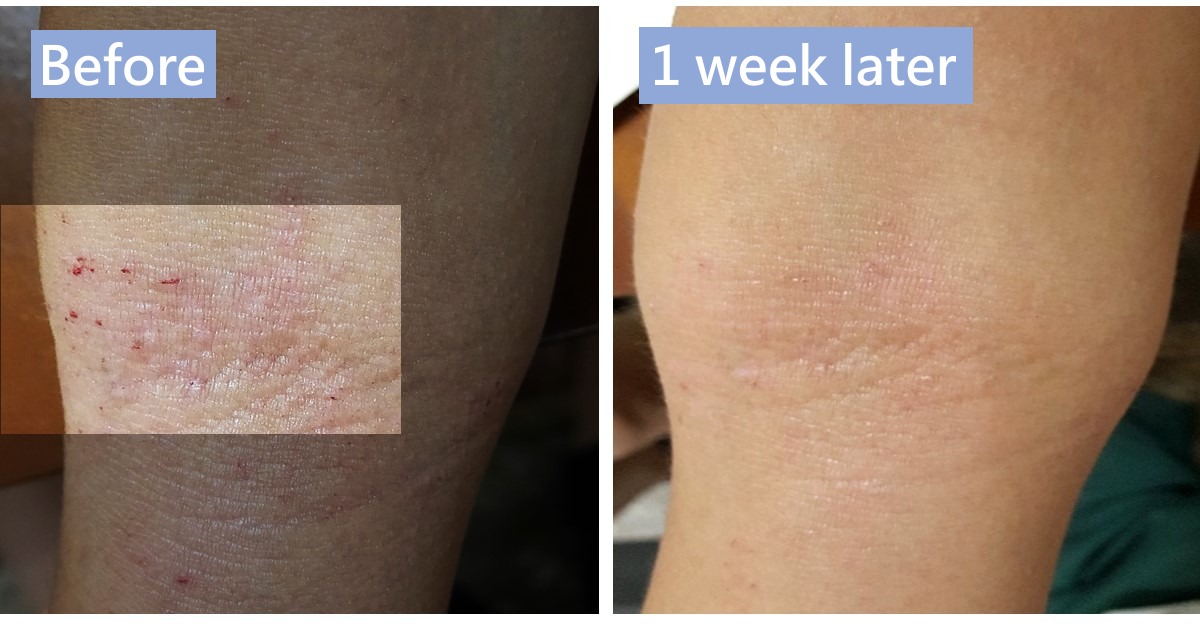 Before-and-after photos of a scratched area of skin, labelled “Before” and “1 week later”