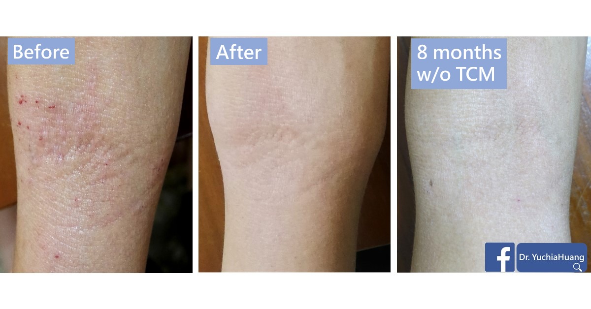 Before-and-after photos of the skin behind the knee, labelled “Before”, “After” and “8 months w/o TCM”