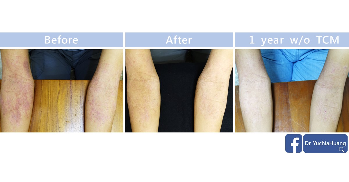 Before-and-after photos of both forearms, labelled “Before”, “After” and “1 year w/o TCM”