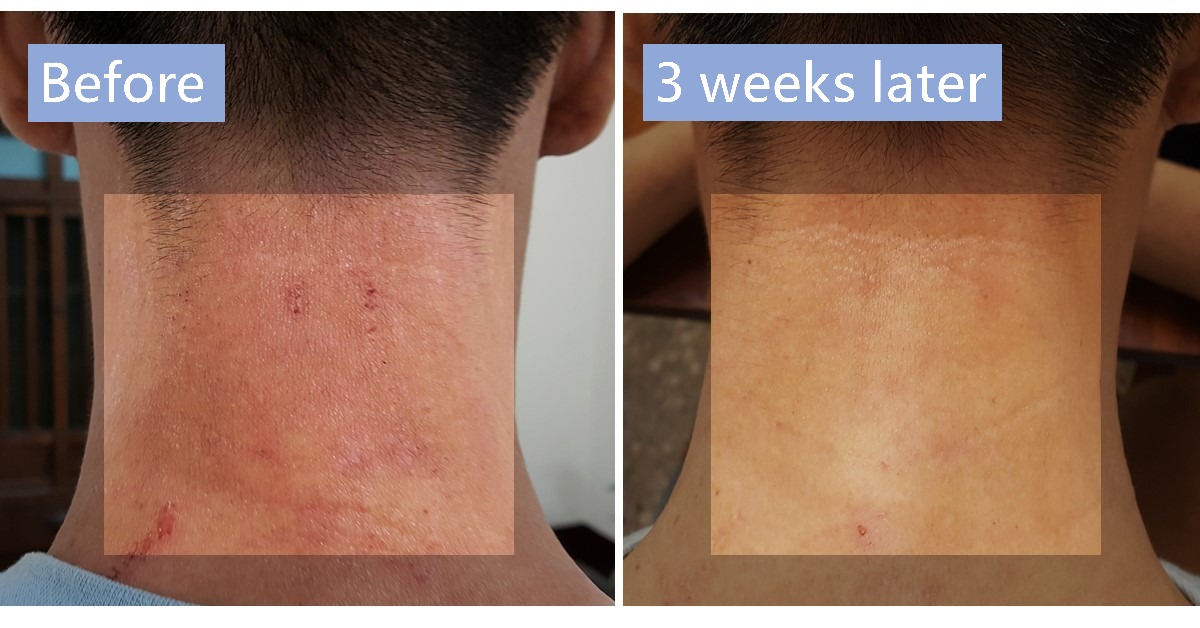Before-and-after photos of the back of the neck, labelled “Before” and “3 weeks later”