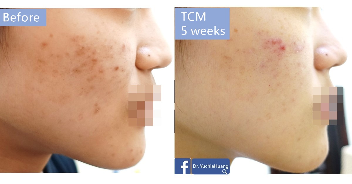 Before-and-after photos of the side of a face with acne, labelled “Before” and “TCM 5 weeks”