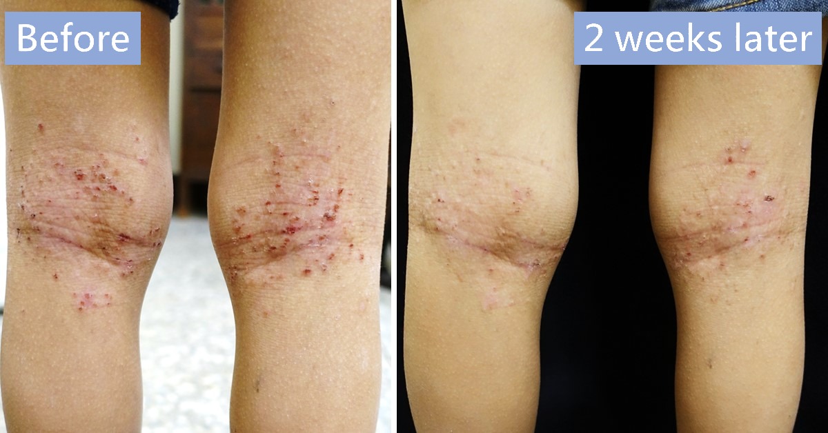 Before-and-after photos of the back of the knees, labelled “Before” and “2 weeks later”
