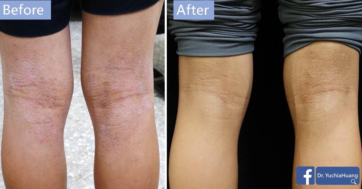 Before-and-after photos of the back of the knees, labelled “Before” and “After”