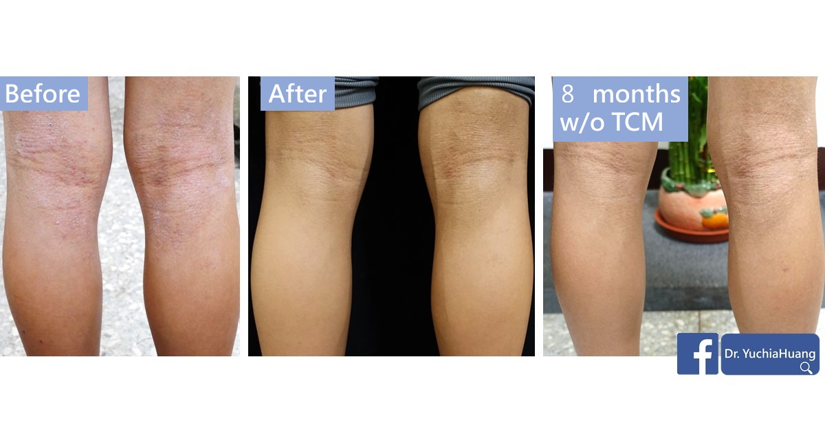 Before-and-after photos of the back of the knees, labelled “Before”, “After” and “8 months w/o TCM”
