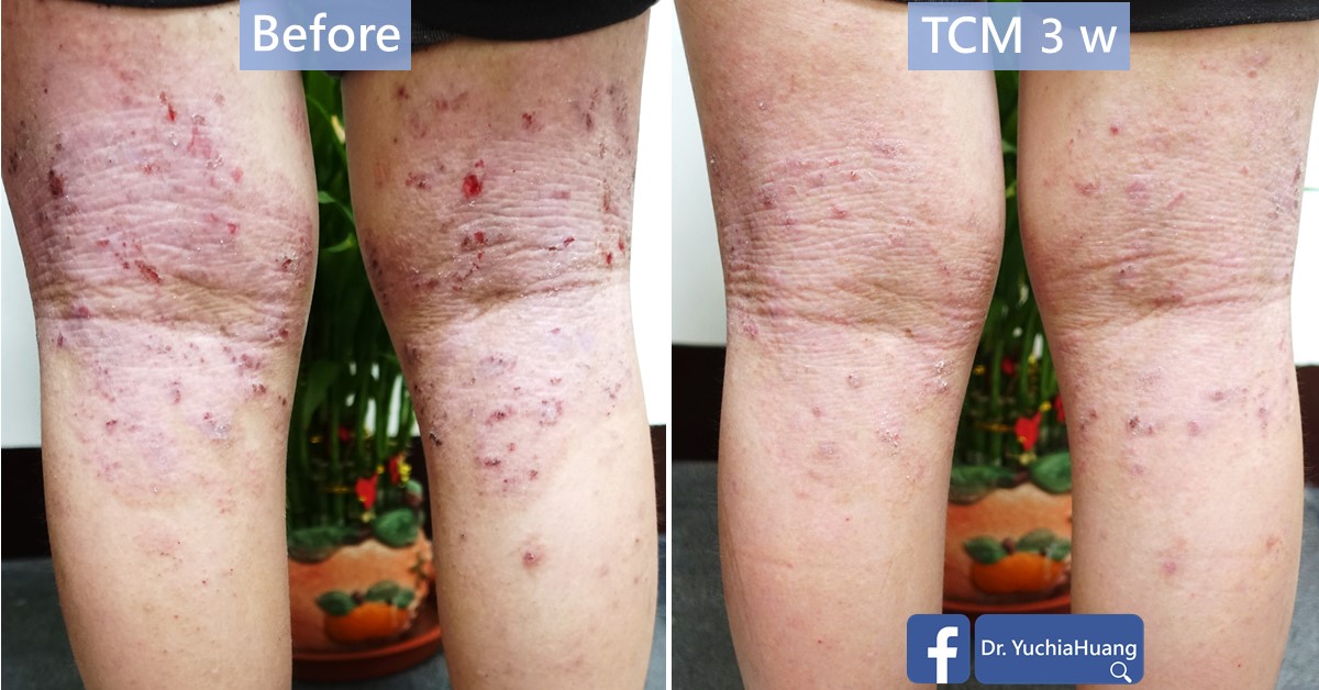 Before-and-after photos of the back of the knees with scratched eczema, labelled “Before” and “TCM 3 weeks”