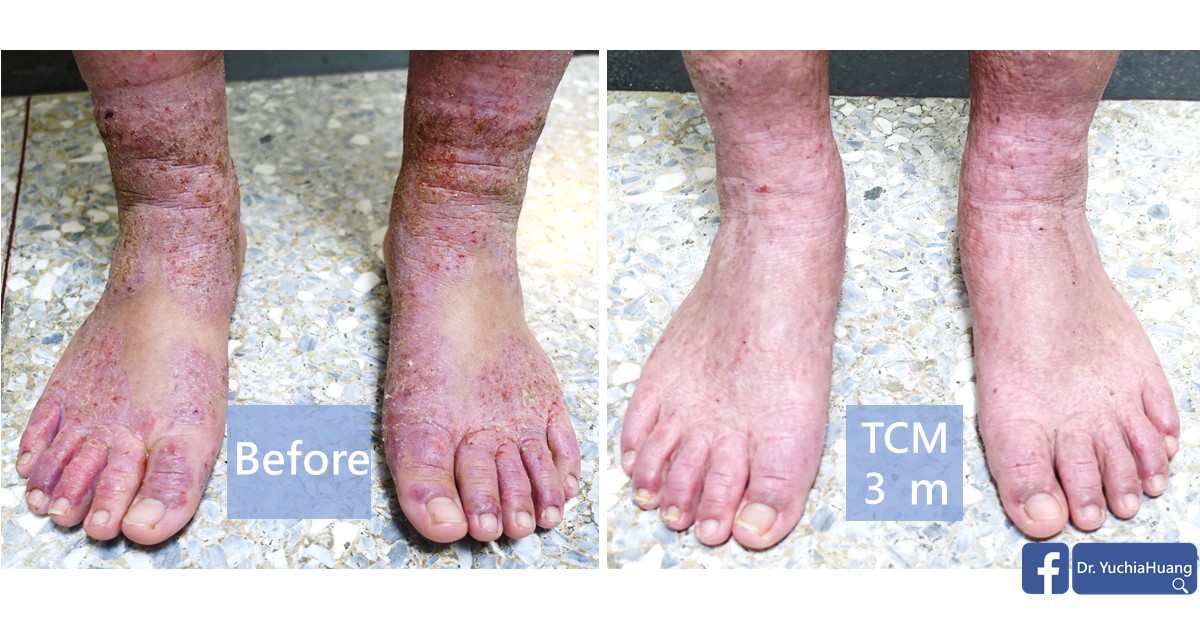 Before-and-after photos of both feet and ankles, labelled “Before” and “TCM 3 months”