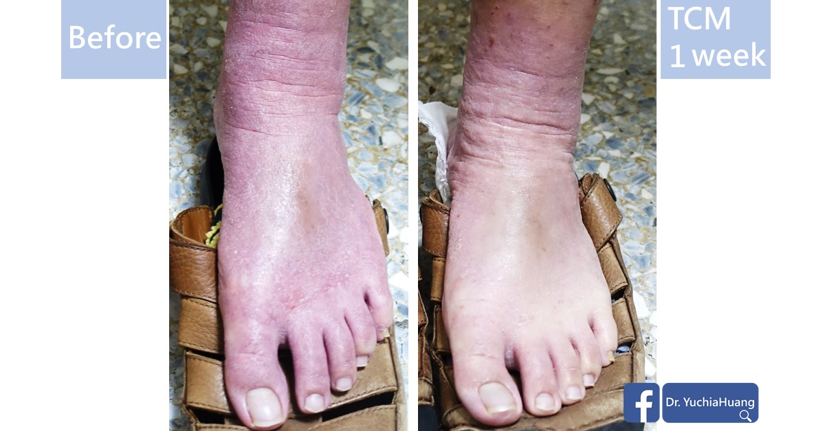 Before-and-after photos of the top of a foot, labelled “Before” and “TCM 1 week”