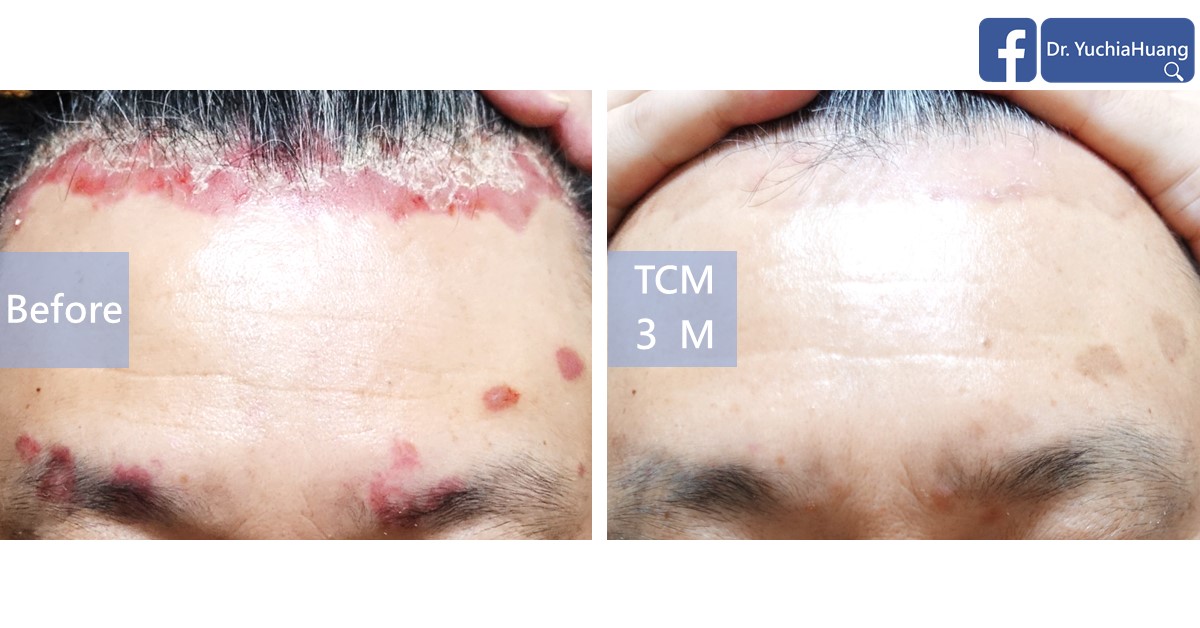 Before-and-after photos of psoriasis along the hairline and forehead, labelled “Before” and “TCM 3 months”