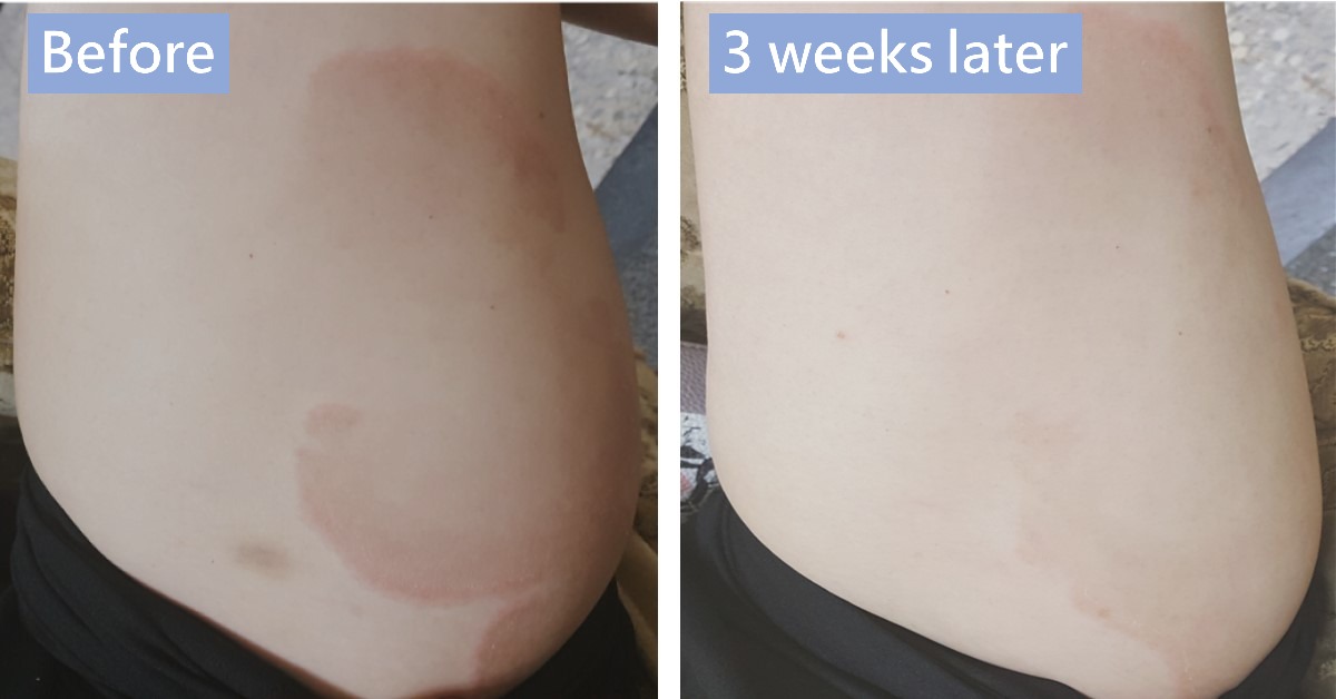 Before-and-after photos of red patches on the side of the waist, labelled “Before” and “3 weeks later”