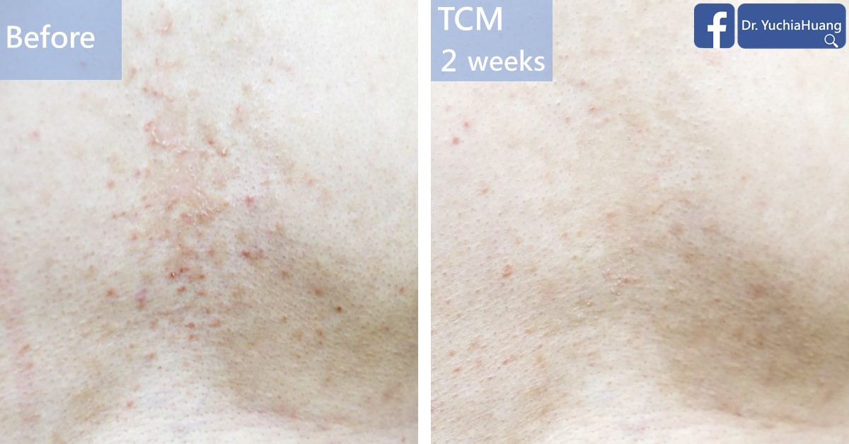 Before-and-after photos of small red spots on the skin, labelled “Before” and “TCM 2 weeks”