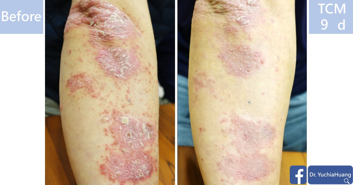 Before-and-after photos of psoriasis plaques on a lower leg, labelled “Before” and “TCM 9 days”