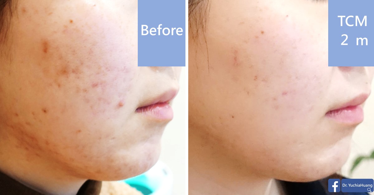 Before-and-after photos of a cheek with acne, labelled “Before” and “TCM 2 months”
