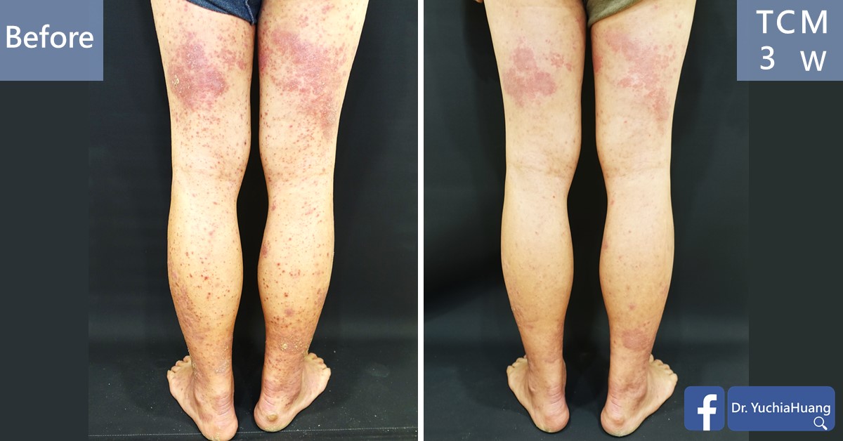 Before-and-after photos of the back of both legs, labelled “Before” and “TCM 3 weeks”