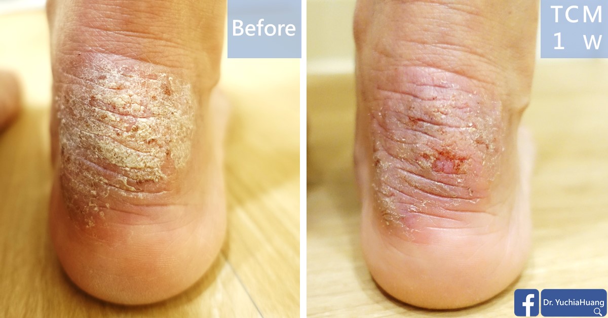 Before-and-after photos of a cracked, thickened heel, labelled “Before” and “TCM 1 week”