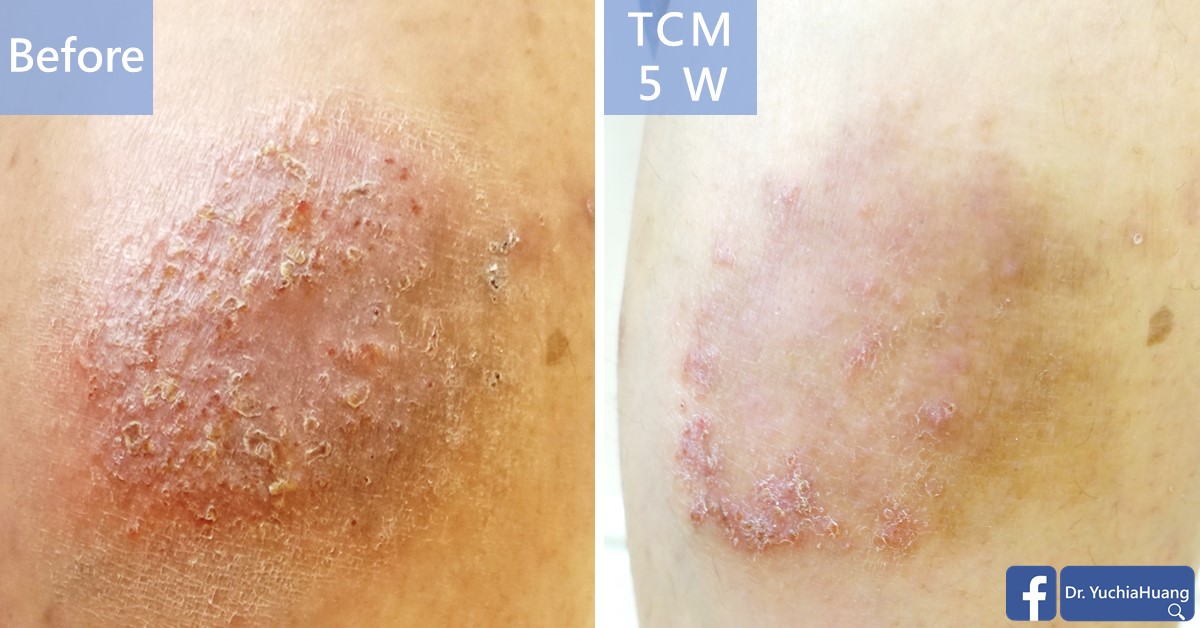 Before-and-after photos of a thickened, crusted patch of eczema, labelled “Before” and “TCM 5 weeks”